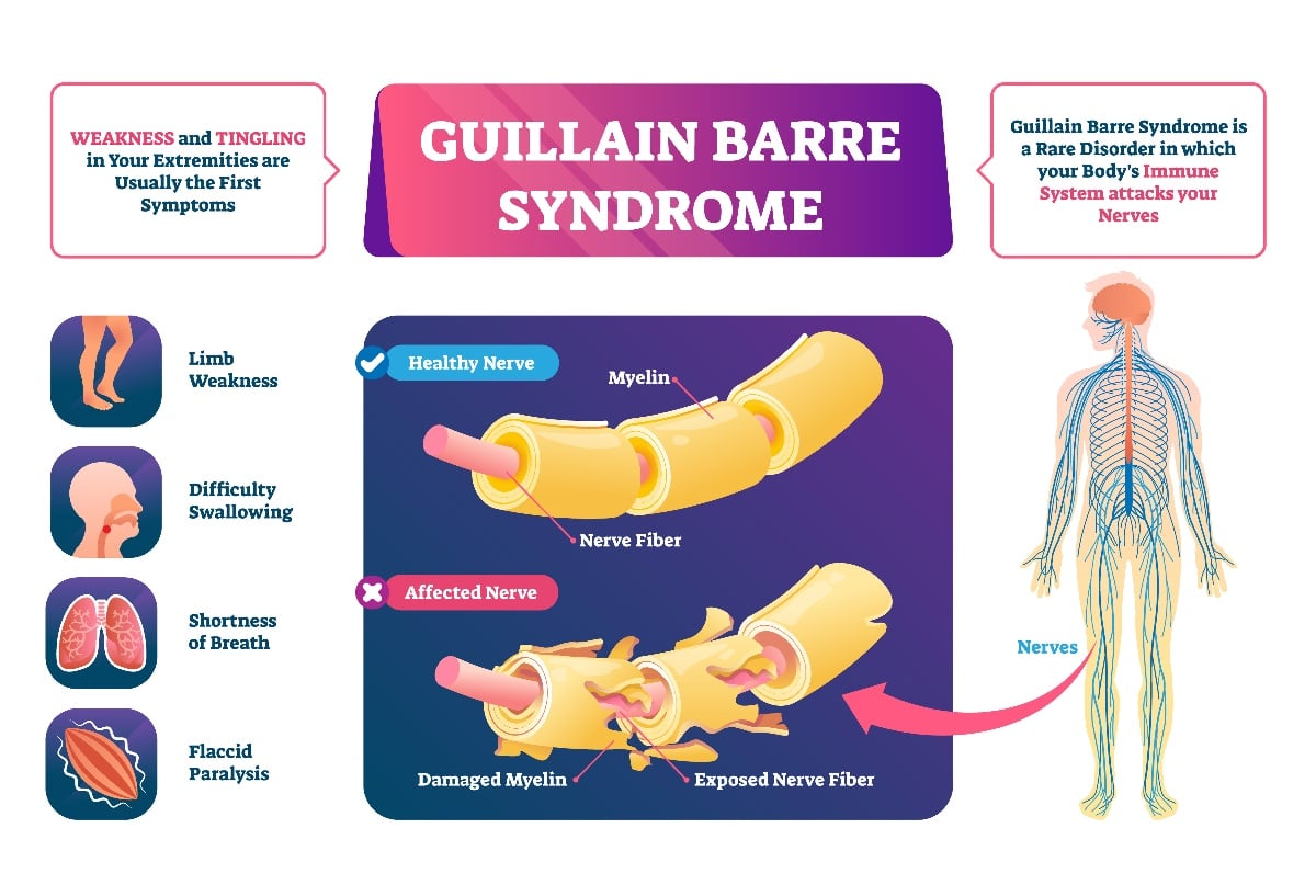 Guillain Barre Syndrome - My Vaccine Lawyer-1