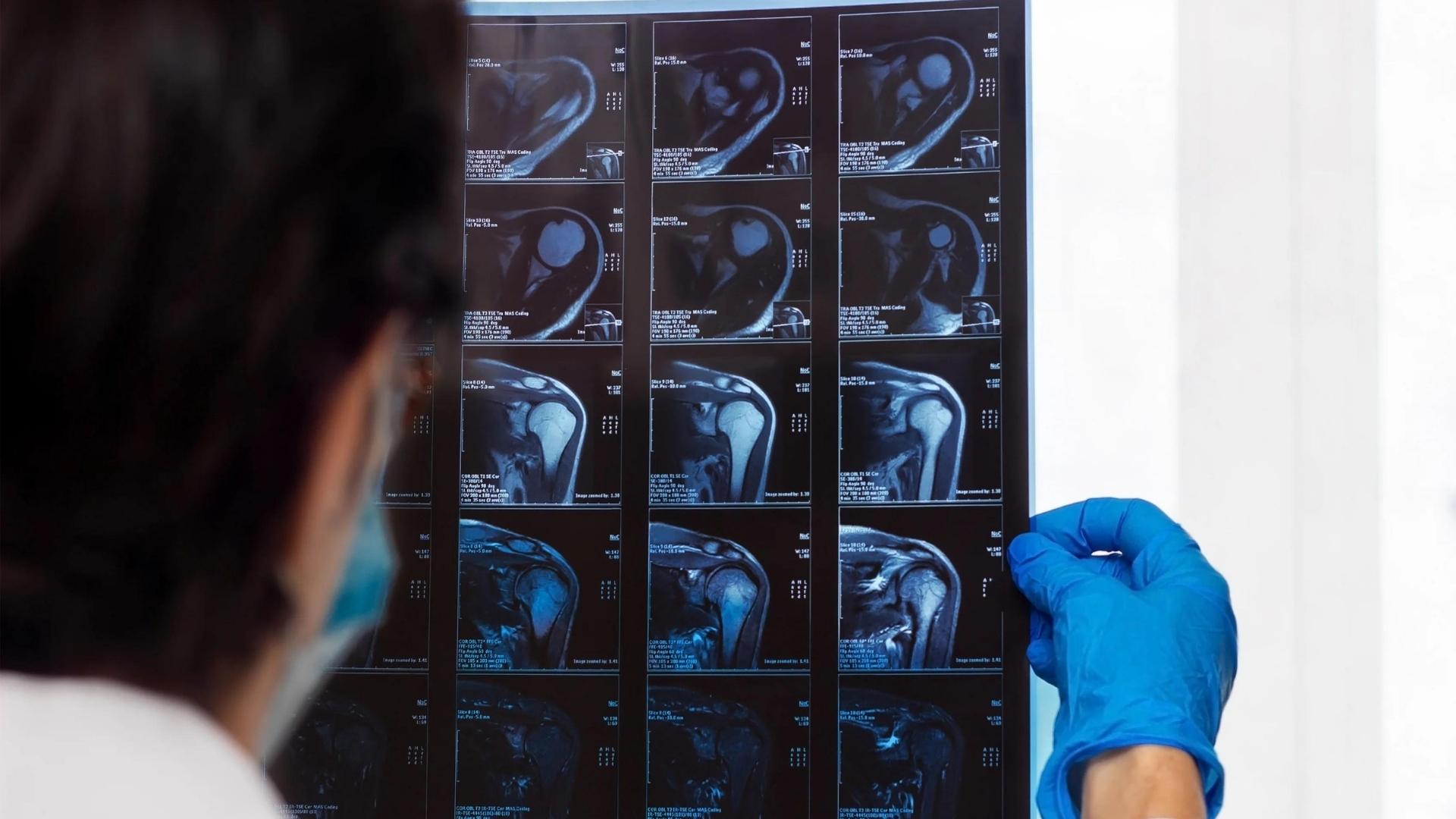 Frozen Shoulder from Vaccine | My Vaccine Lawyer